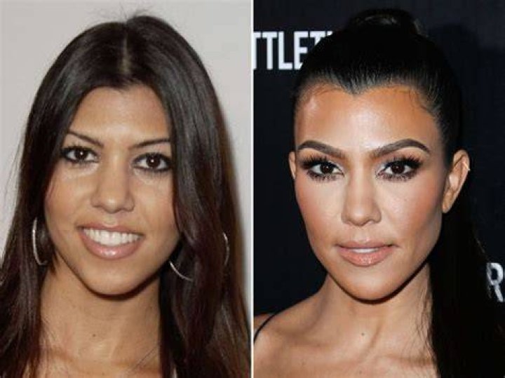 khlo&eacute; kardashian before and after face