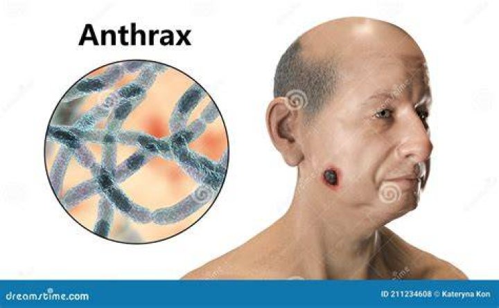 L0029731 Woman With Anthrax Sore On Face.