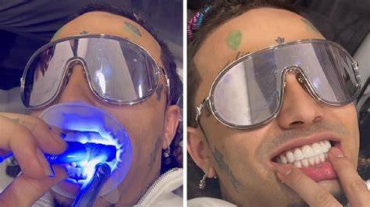 Lil Pump Gets $25,000 Teeth Makeover