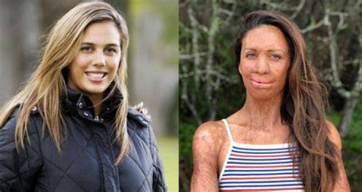 Turia Pitt’s story — Her recovery from 65% burns