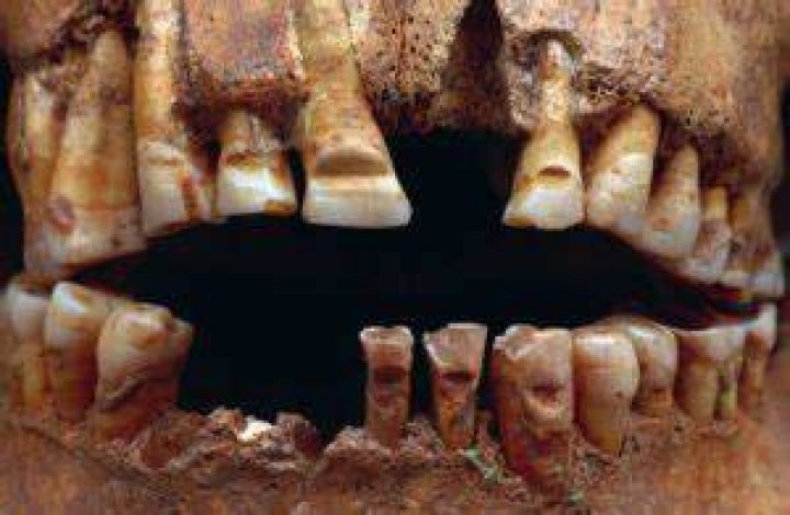 Viking Teeth Modification